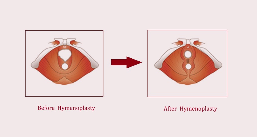Hymenoplasty Repair in Tijuana Cost